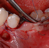 Implantation-Chirurgie Teil II